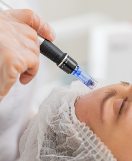 Dermapen Microneedling